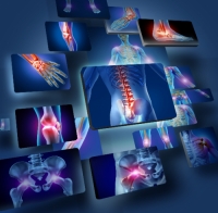 Dados da IQVIA revelam mapa da artrite reumatoide